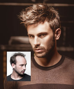 Boston mens hair replacement systems